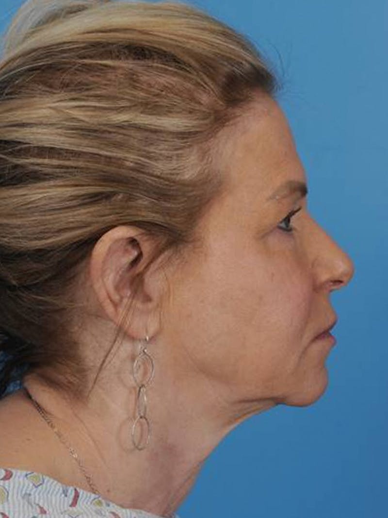Facelift Before & After Gallery - Patient 180437 - Image 5