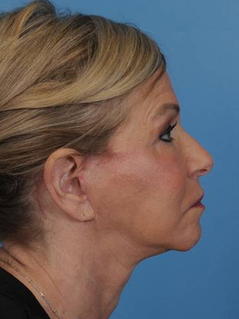Facelift Before & After Gallery - Patient 180437 - Image 6