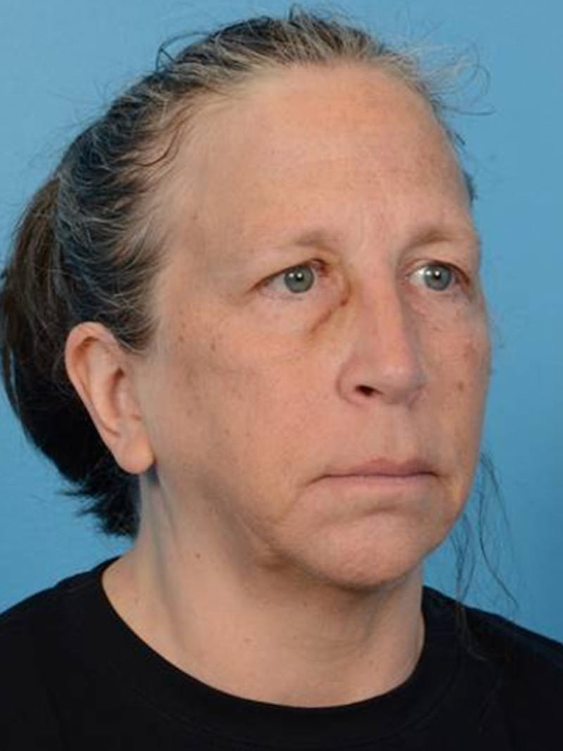 Facelift Before & After Gallery - Patient 406936 - Image 3