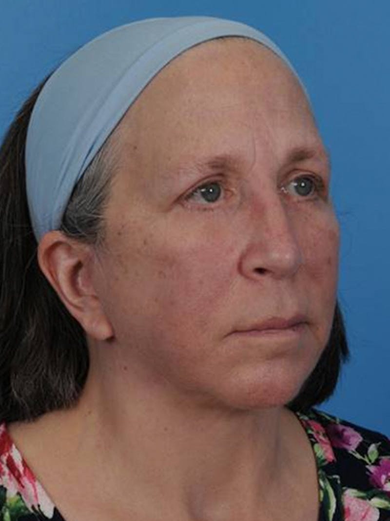 Facelift Before & After Gallery - Patient 406936 - Image 4