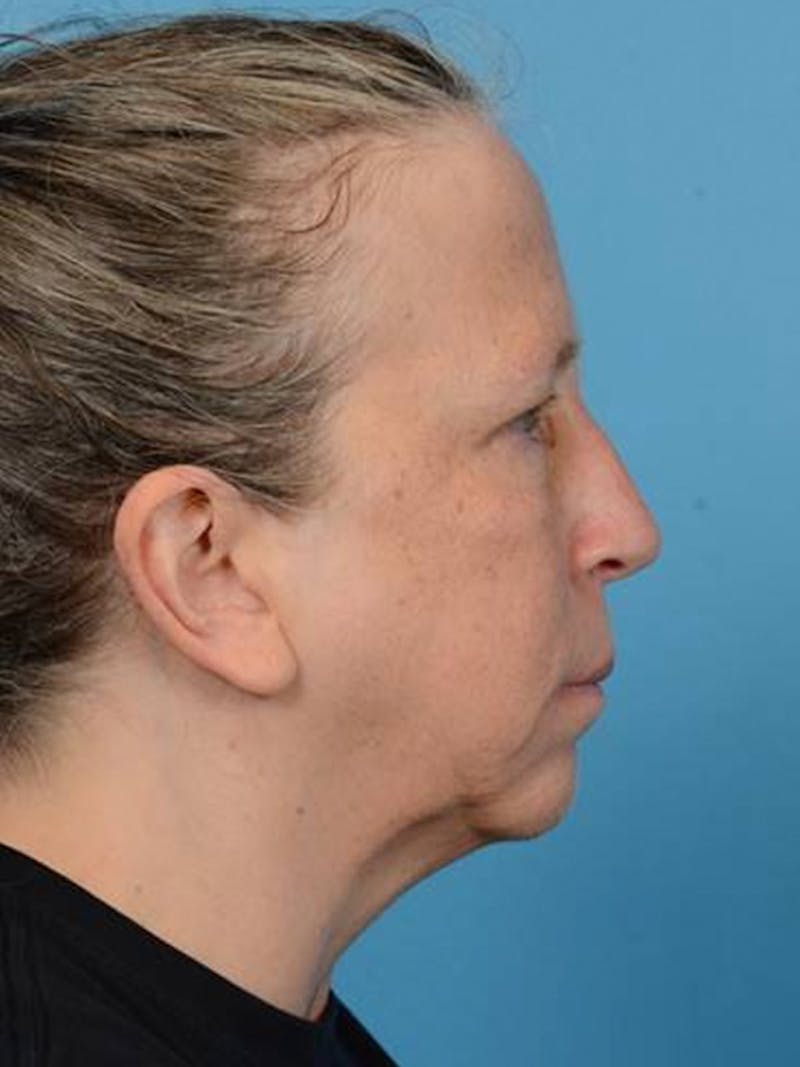 Facelift Before & After Gallery - Patient 406936 - Image 5