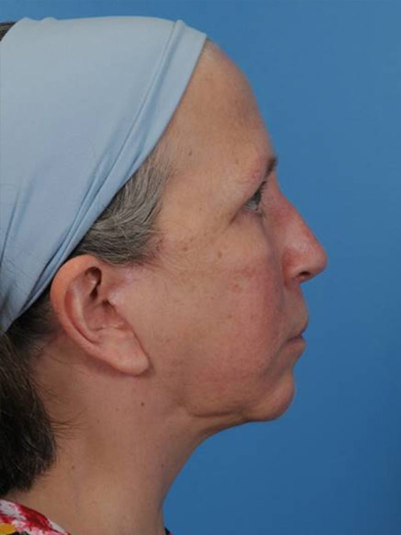 Facelift Before & After Gallery - Patient 406936 - Image 6