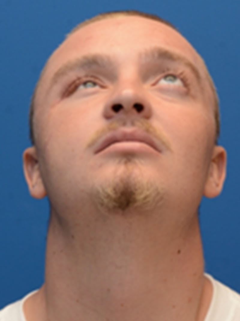 Facial Trauma Repair Before & After Gallery - Patient 320415 - Image 3