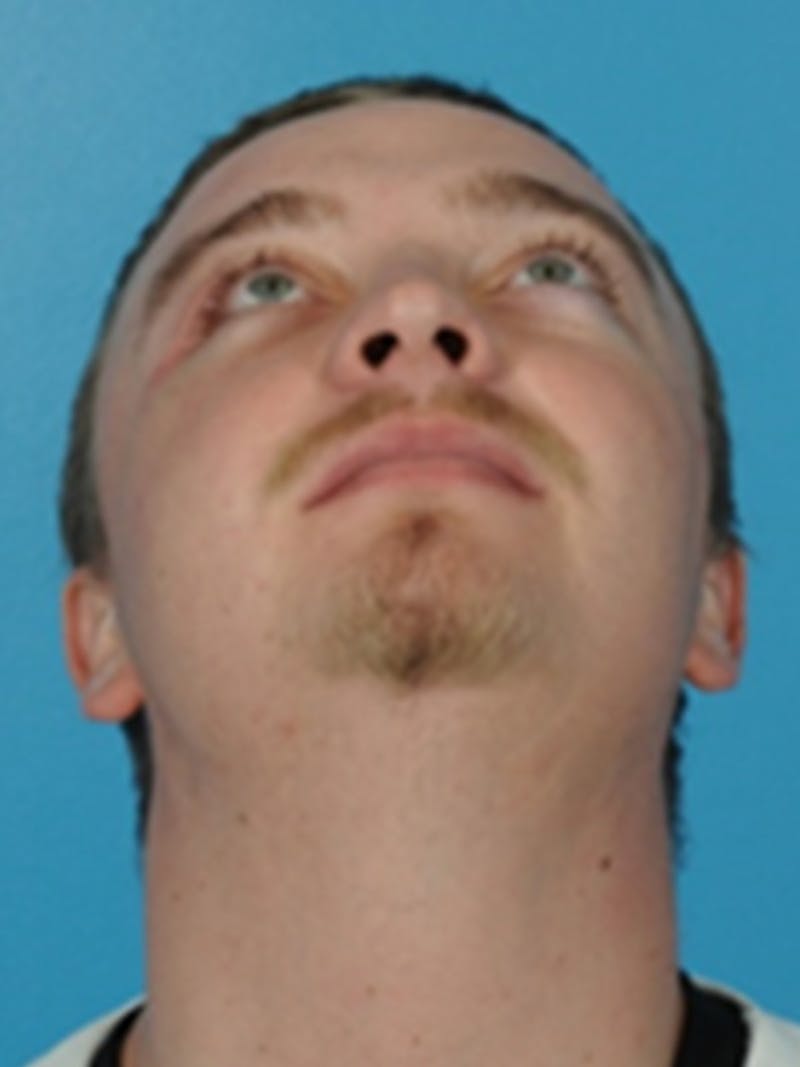 Facial Trauma Repair Before & After Gallery - Patient 320415 - Image 4