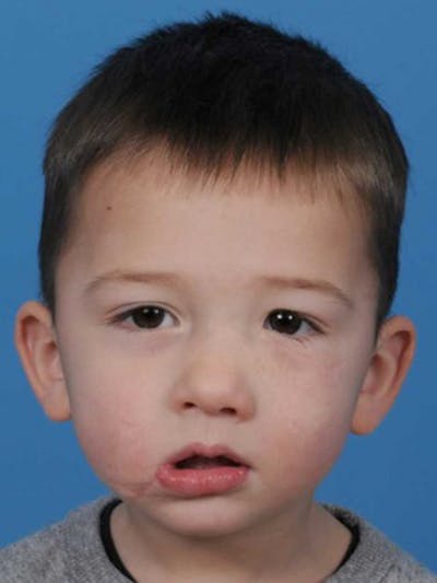 Facial Trauma Repair Before & After Gallery - Patient 390678 - Image 2