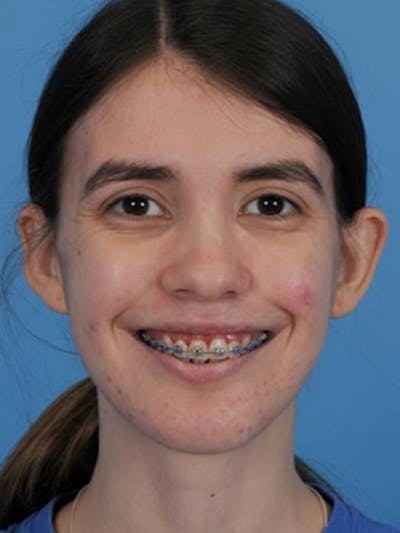 Orthognathic (Jaw ) Surgery Before & After Gallery - Patient 880384 - Image 2