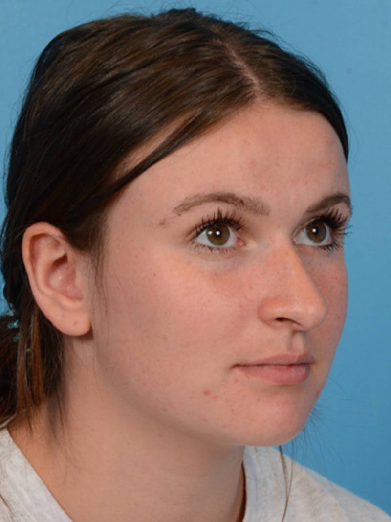 Rhinoplasty Before & After Gallery - Patient 340563 - Image 3
