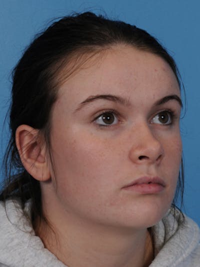 Rhinoplasty Before & After Gallery - Patient 340563 - Image 2