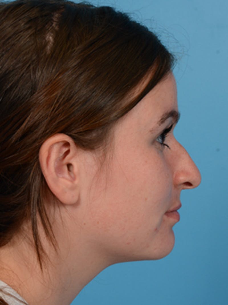 Rhinoplasty Before & After Gallery - Patient 340563 - Image 5
