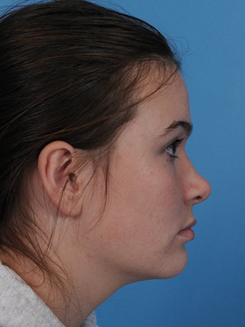 Rhinoplasty Before & After Gallery - Patient 340563 - Image 6