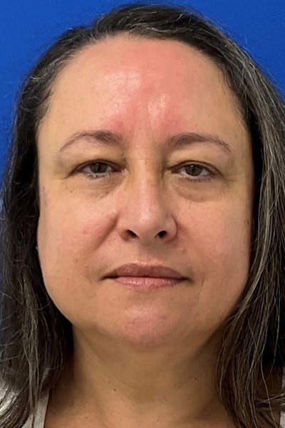 Blepharoplasty Before & After Gallery - Patient 183946 - Image 1