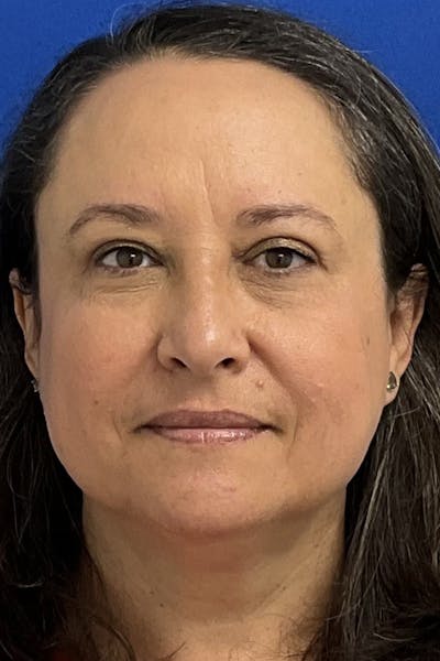 Blepharoplasty Before & After Gallery - Patient 183946 - Image 2