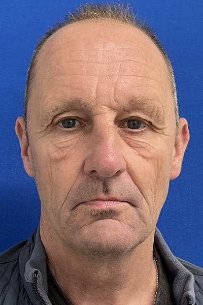 Blepharoplasty Before & After Gallery - Patient 149138 - Image 1