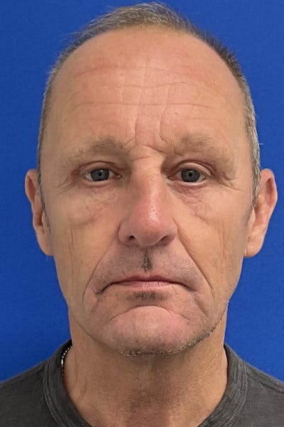 Blepharoplasty Before & After Gallery - Patient 149138 - Image 2