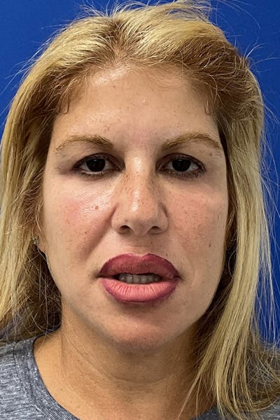 Blepharoplasty Before & After Gallery - Patient 919647 - Image 1