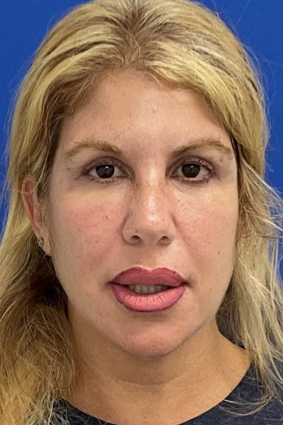 Blepharoplasty Before & After Gallery - Patient 919647 - Image 2