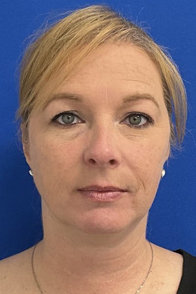 Blepharoplasty Before & After Gallery - Patient 168879 - Image 1