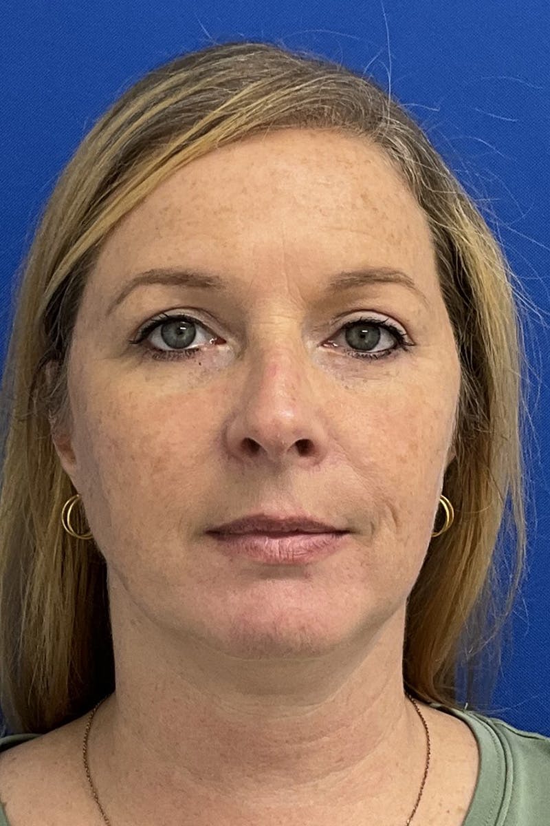 Blepharoplasty Before & After Gallery - Patient 168879 - Image 2