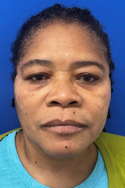 Blepharoplasty Before & After Gallery - Patient 195448 - Image 1