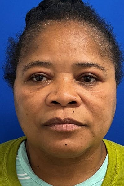 Blepharoplasty Before & After Gallery - Patient 195448 - Image 2