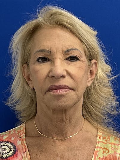 Facelift Before & After Gallery - Patient 381812 - Image 1
