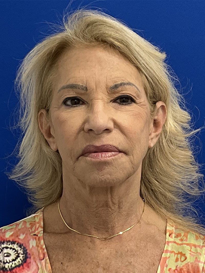 Facelift Before & After Gallery - Patient 381812 - Image 1