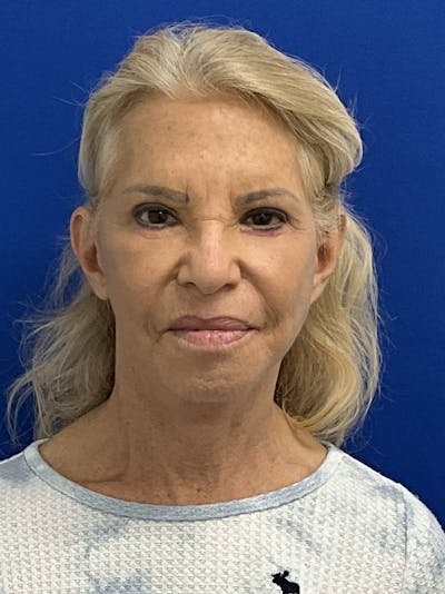Facelift Before & After Gallery - Patient 381812 - Image 2