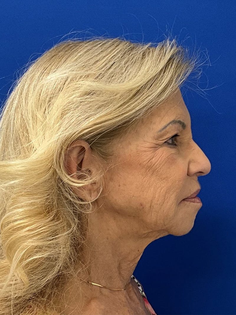 Facelift Before & After Gallery - Patient 381812 - Image 3
