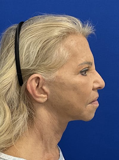 Neck Lift Before & After Gallery - Patient 462353 - Image 2