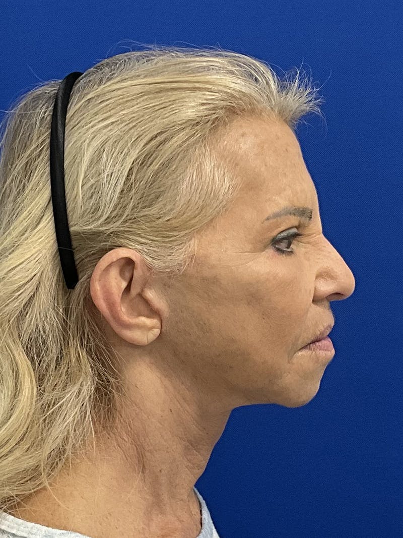 Facelift Before & After Gallery - Patient 381812 - Image 4