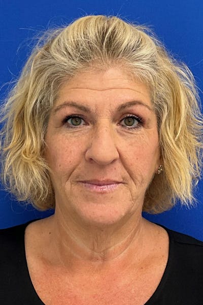 Blepharoplasty Before & After Gallery - Patient 350071 - Image 2