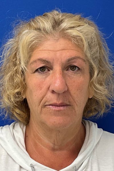 Blepharoplasty Before & After Gallery - Patient 350071 - Image 1