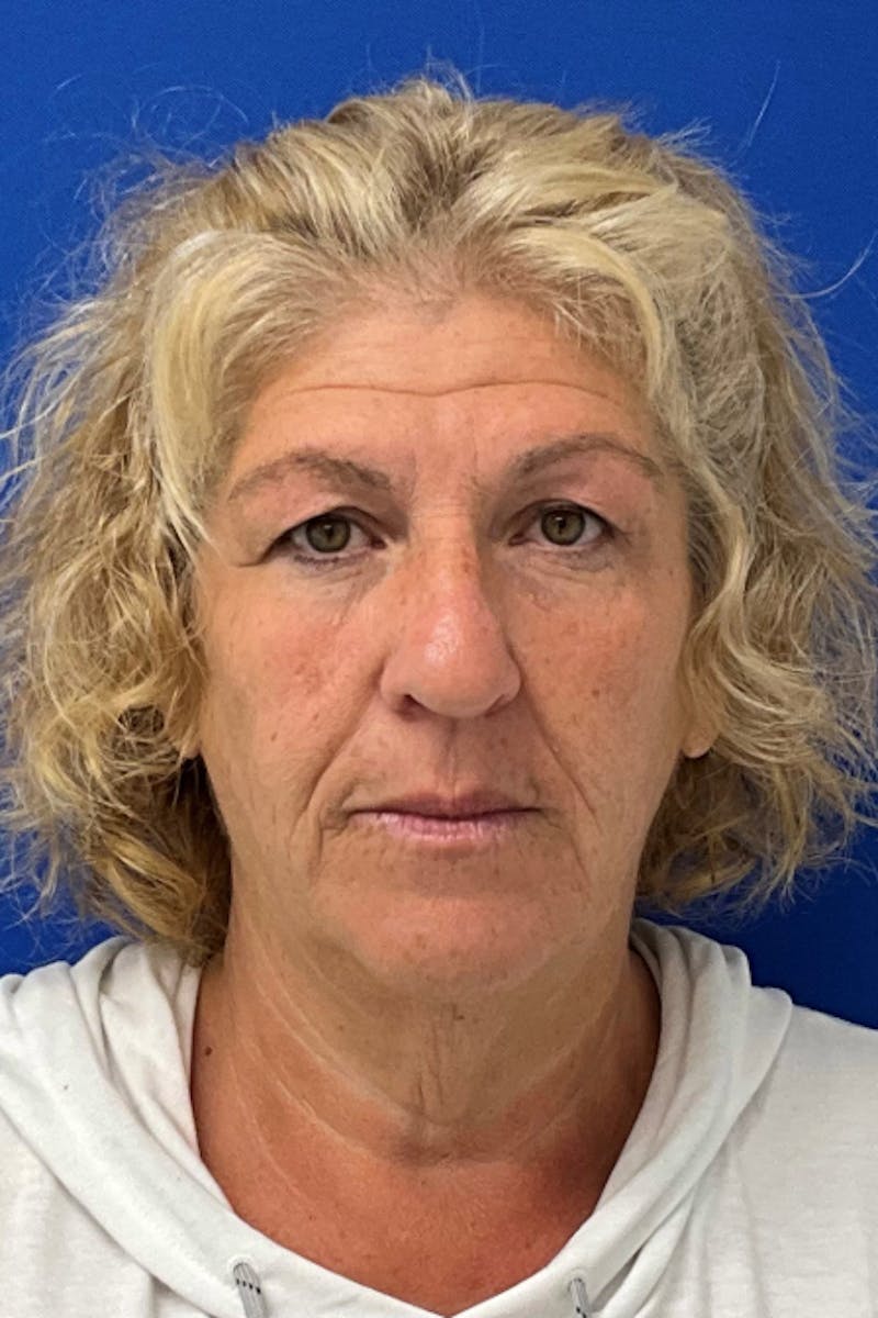 Blepharoplasty Before & After Gallery - Patient 350071 - Image 1