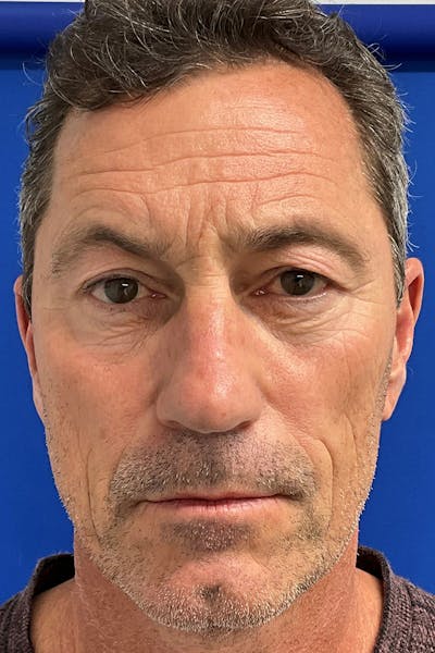 Blepharoplasty Before & After Gallery - Patient 333767 - Image 1