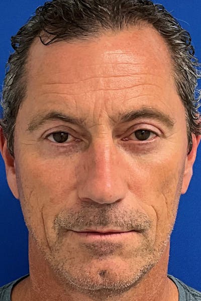 Blepharoplasty Before & After Gallery - Patient 333767 - Image 2