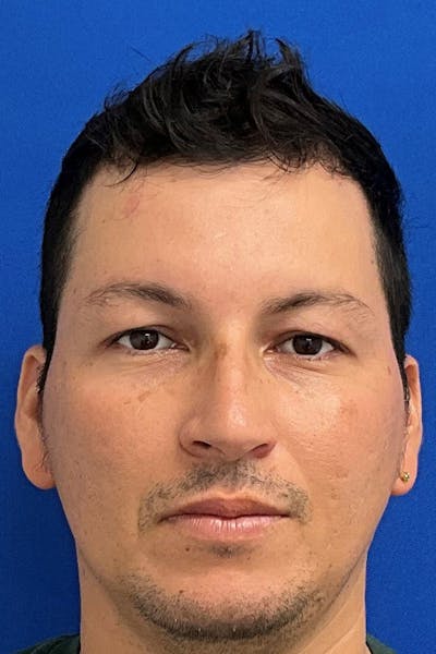 Blepharoplasty Before & After Gallery - Patient 269690 - Image 1