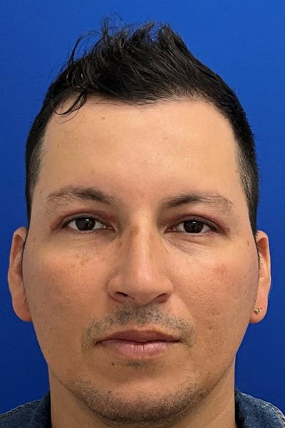 Blepharoplasty Before & After Gallery - Patient 269690 - Image 2