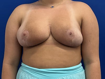 Breast Reduction Before & After Gallery - Patient 164462 - Image 2
