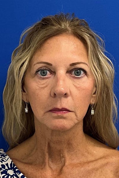 Facelift Before & After Gallery - Patient 239751 - Image 1