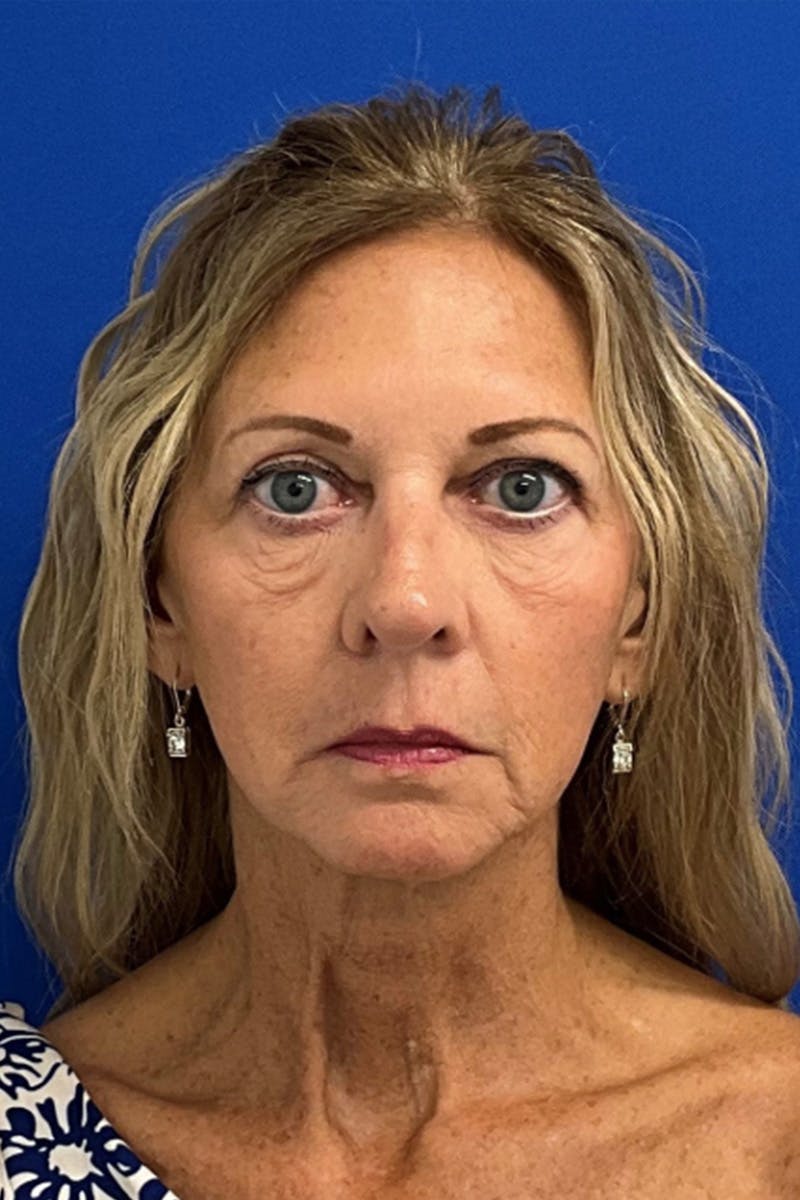 Facelift Before & After Gallery - Patient 239751 - Image 1