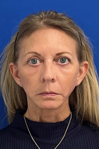Facelift Before & After Gallery - Patient 239751 - Image 2