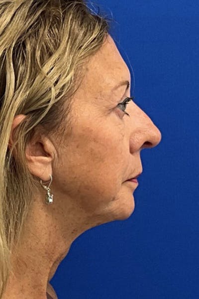 Neck Lift Before & After Gallery - Patient 198295 - Image 1
