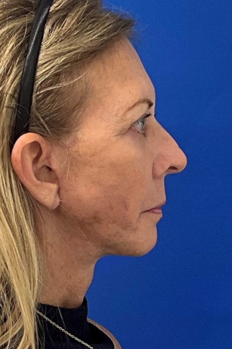 Facelift Before & After Gallery - Patient 239751 - Image 4