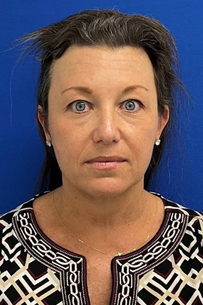 Facelift Before & After Gallery - Patient 280108 - Image 1