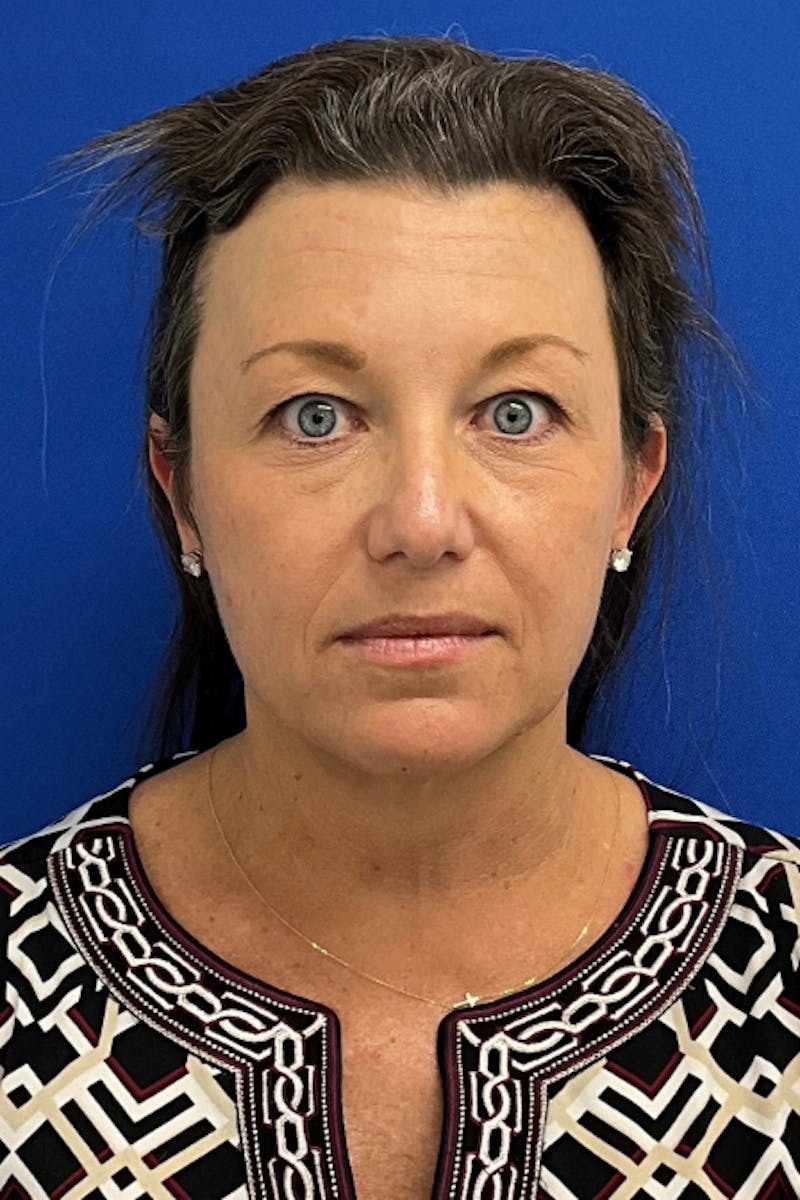 Facelift Before & After Gallery - Patient 280108 - Image 1
