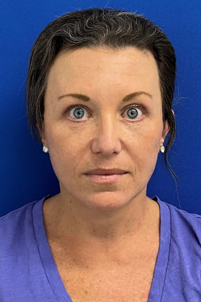Facelift Before & After Gallery - Patient 280108 - Image 2