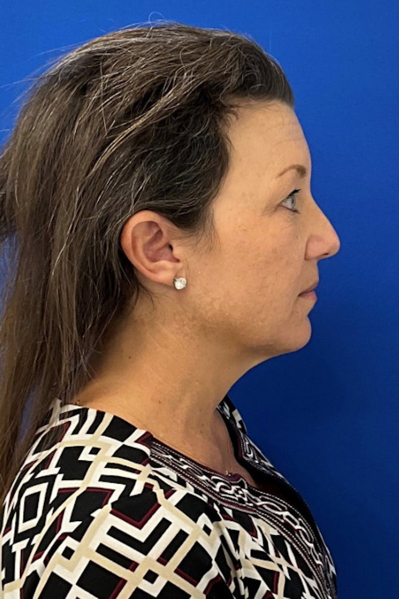 Facelift Before & After Gallery - Patient 280108 - Image 3