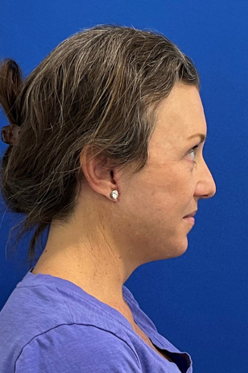 Facelift Before & After Gallery - Patient 280108 - Image 4