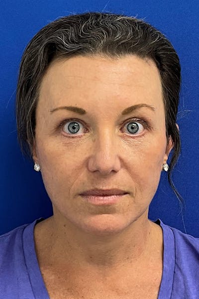 Facelift Before & After Gallery - Patient 427335 - Image 2