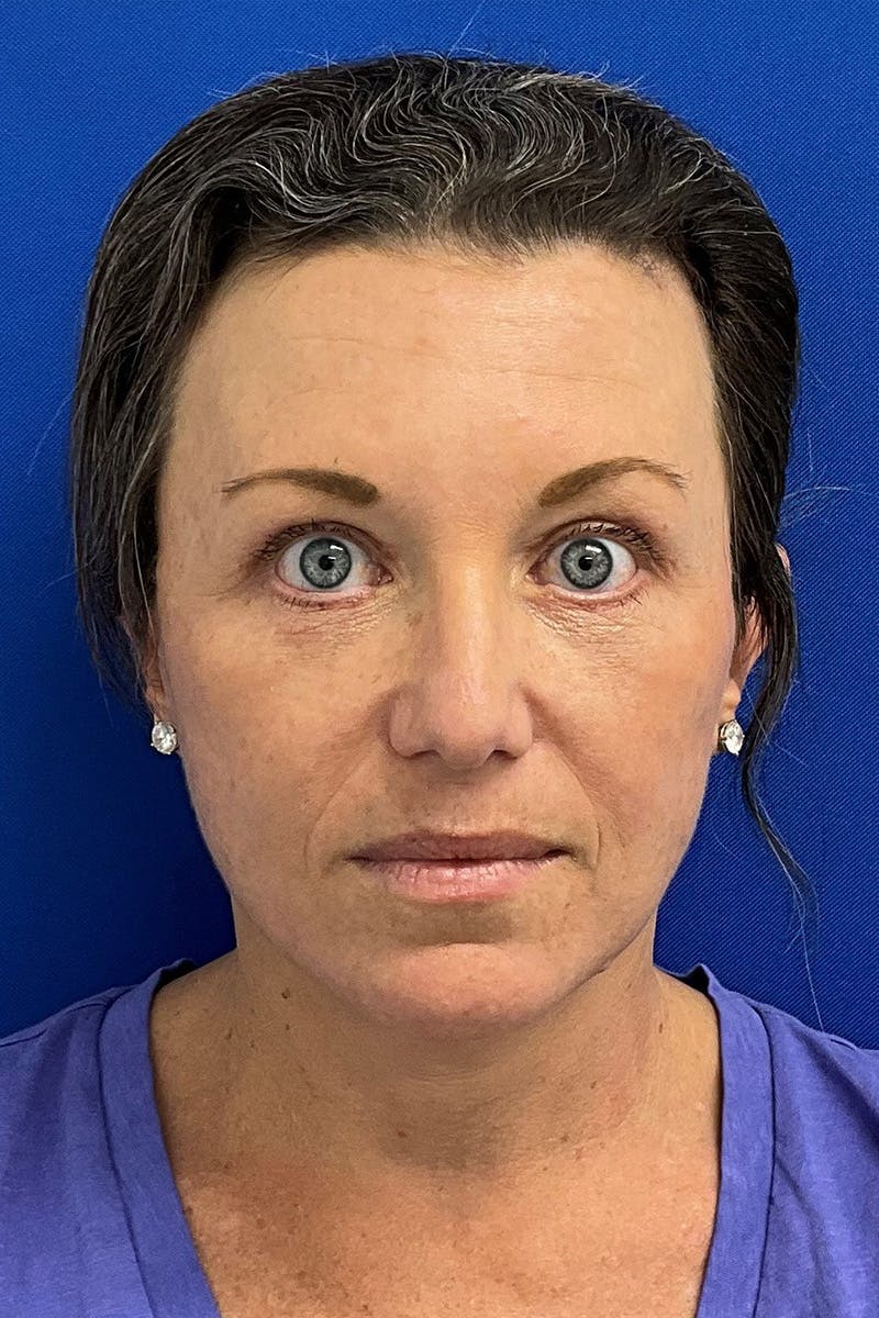 Facelift Before & After Gallery - Patient 427335 - Image 2